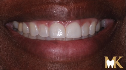 After smile transformation at MK Dental Studio