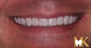 After smile transformation at MK Dental Studio