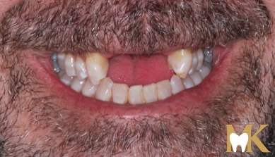 Before smile transformation at MK Dental Studio