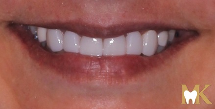 After smile transformation at MK Dental Studio