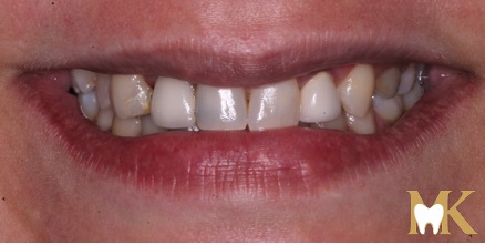 Before smile transformation at MK Dental Studio