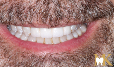 After smile transformation at MK Dental Studio