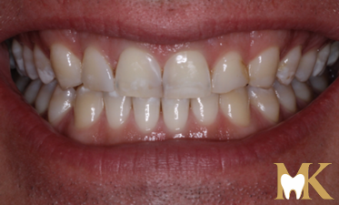 Before smile transformation at MK Dental Studio