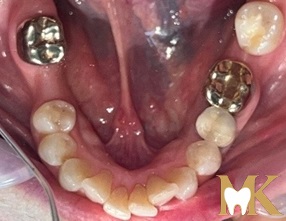 Before smile transformation at MK Dental Studio