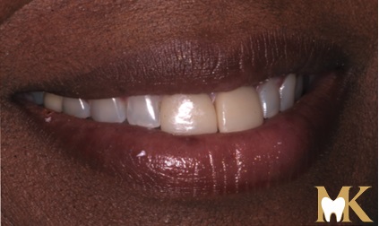 Before smile transformation at MK Dental Studio