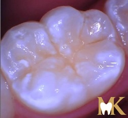 Before smile transformation at MK Dental Studio