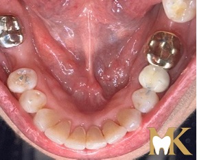 After smile transformation at MK Dental Studio
