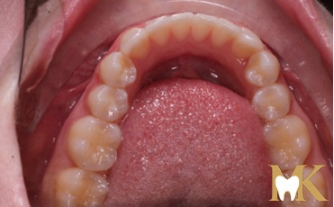 After smile transformation at MK Dental Studio