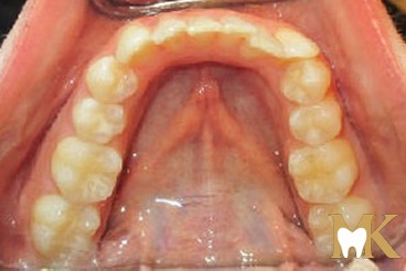 Before smile transformation at MK Dental Studio