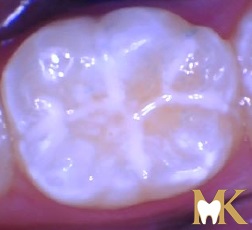 After smile transformation at MK Dental Studio